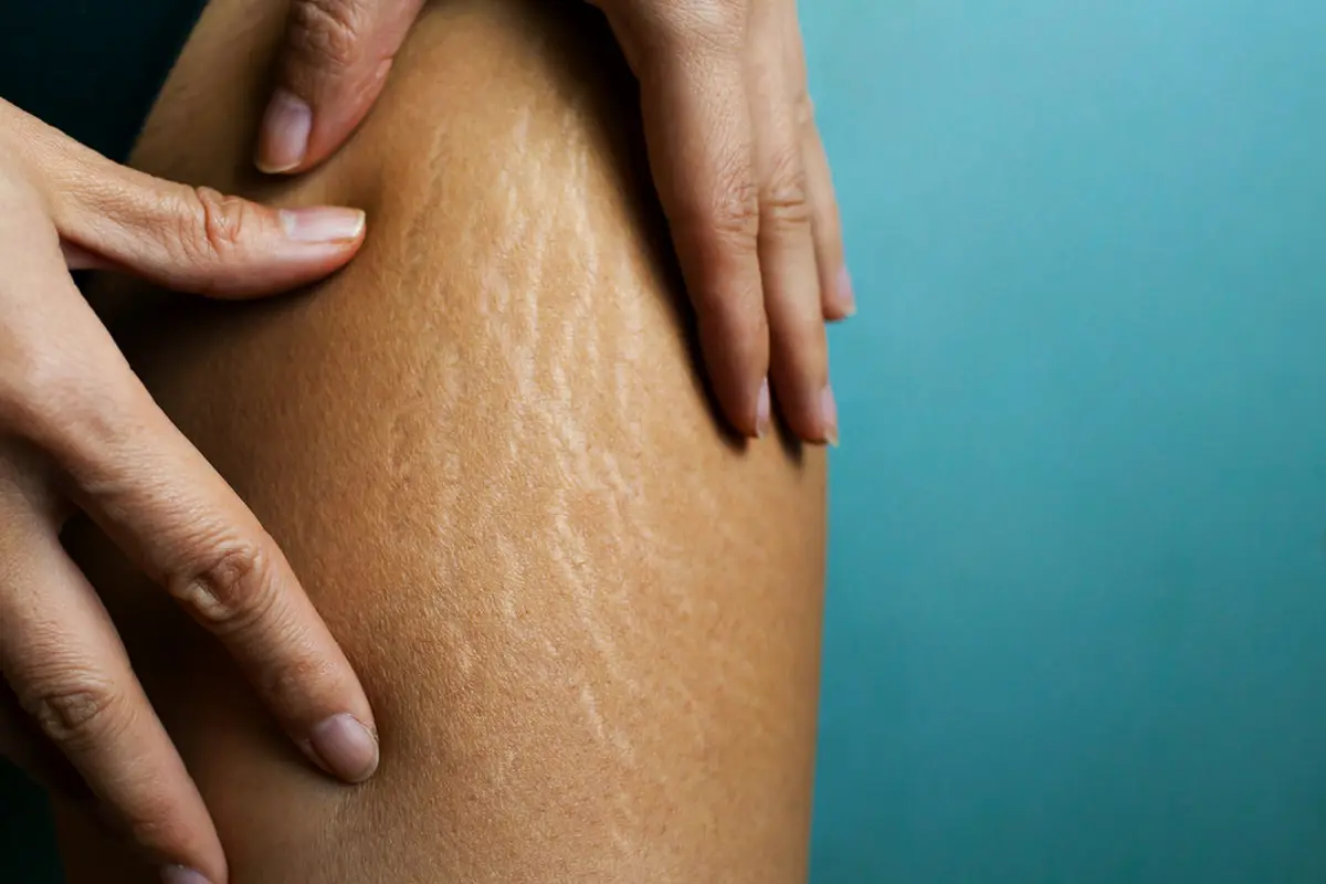 Ilustrasi stretch mark
