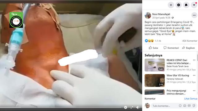 Cek Fakta Video Ini Bukan Prosedur Pengangkatan Dahak Pasien