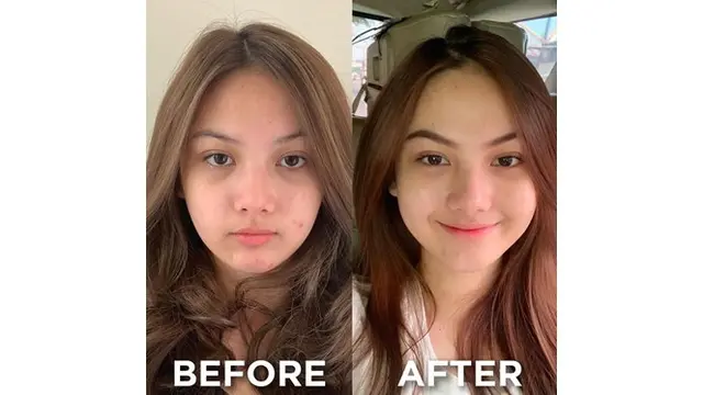 6 Seleb Ini Pernah Unggah Foto saat Wajah Berjerawat, Akui Tak Malu