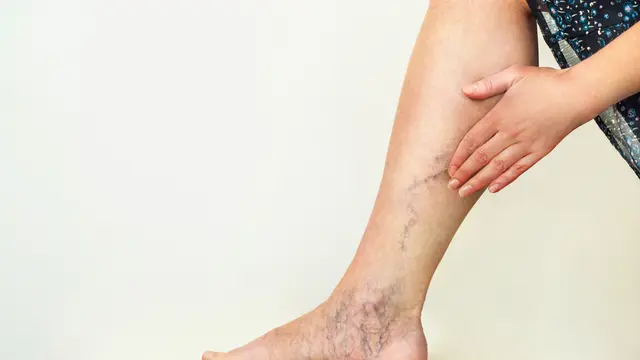 Penyebab Terjadinya Varises Vena