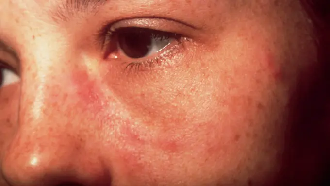 Ini Gejala Awal Penyakit Lupus yang Harus Diwaspadai. (Foto: Shminhe)