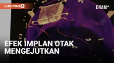 Remaja Inggris berusia 13 tahun, Oran Knowlson, menjadi anak pertama di dunia yang menerima implan otak untuk mengontrol kejang epilepsi. Sebelum operasi implan, Oran mengalami 300 kejang per hari sejak usia tiga tahun.