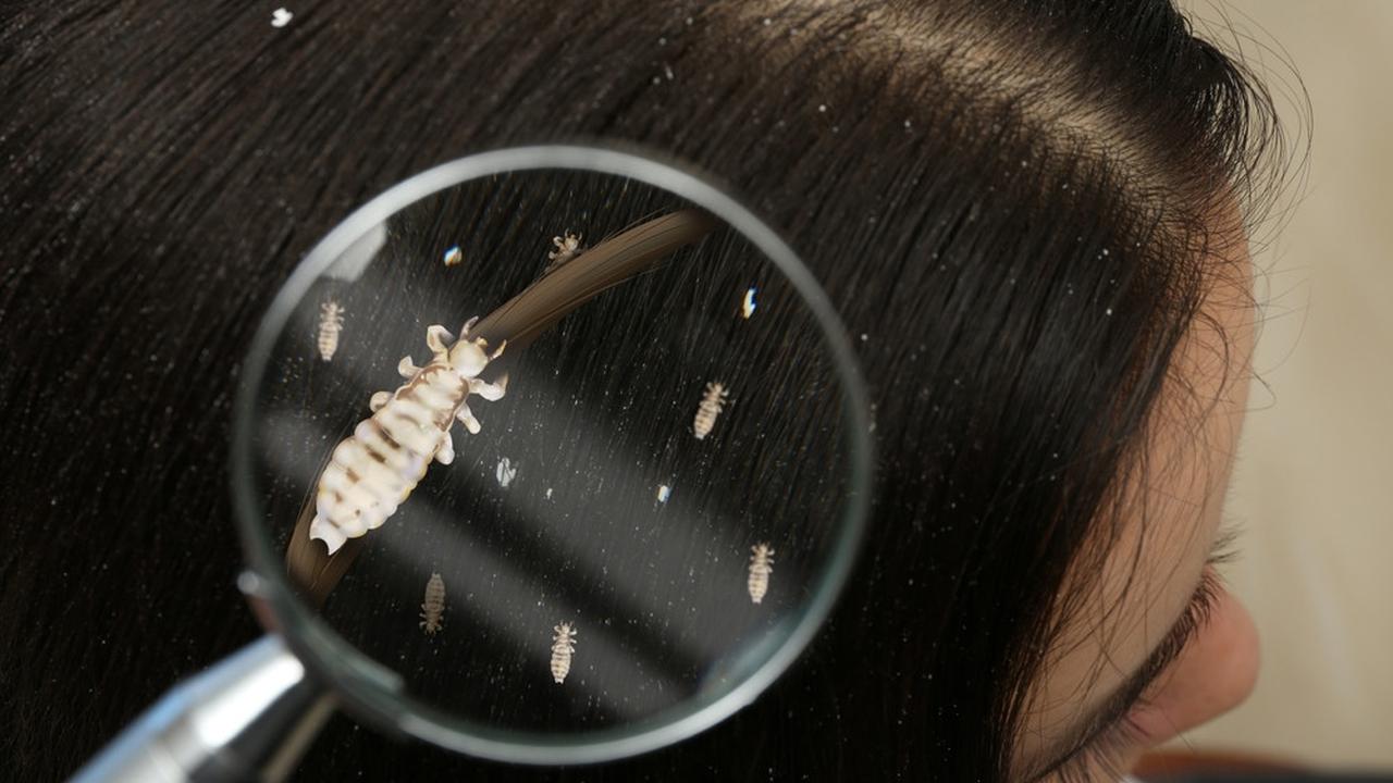 Cara Ampuh Membasmi Kutu Rambut dan Telurnya yang Bikin Kepala Gatal, Intip Yuk