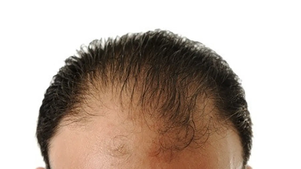 Ilustrasi rambut rontok