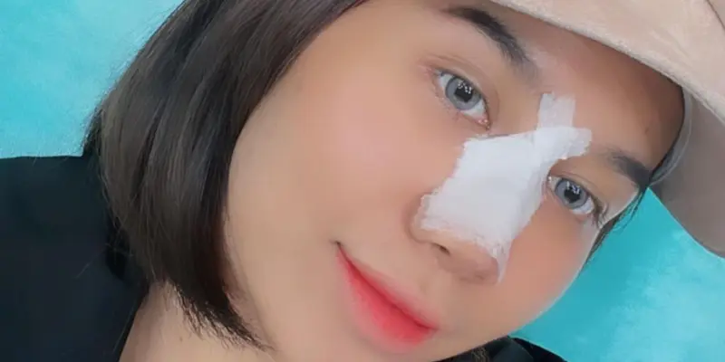 Potret Mayang Lucyana Lepas Perban Usai Operasi Plastik di Bagian Hidung