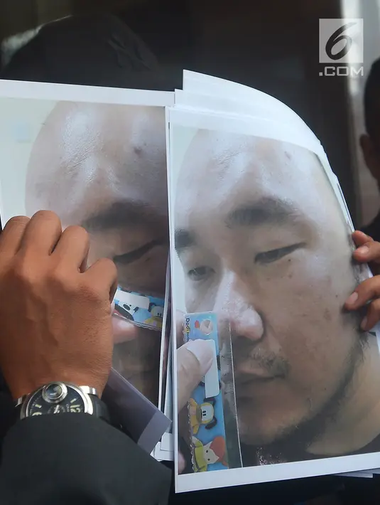 Gambar pelapor penganiayaan, Ronny Yuniarto usai membuat laporan di Polres Metro Jakarta Selatan, Kamis (21/6). Penganiayaan bermula saat Ronny ditilang polisi lalu lintas di Jalan Arteri Pondok Indah, Jaksel, Minggu (10/6). (Merdeka.com/Imam Buhori)