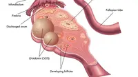 Tanda Kista Ovarium Dilihat dari Vagina