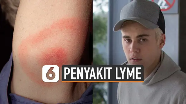 Justin Bieber mengaku didiagnosa menderita penyakit Lyme melalui akun Instagram pribadinya pada Kamis (9/1/2020).