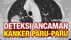 Di Amerika, kanker paru-paru membunuh lebih banyak orang dibanding kanker lain. Namun penelitian kanker paru-paru tidak mendapat perhatian sebesar kanker jenis lain. Namun panduan baru Pusat Pengendalian Penyakit AS merilis panduan baru yang mungkin ...