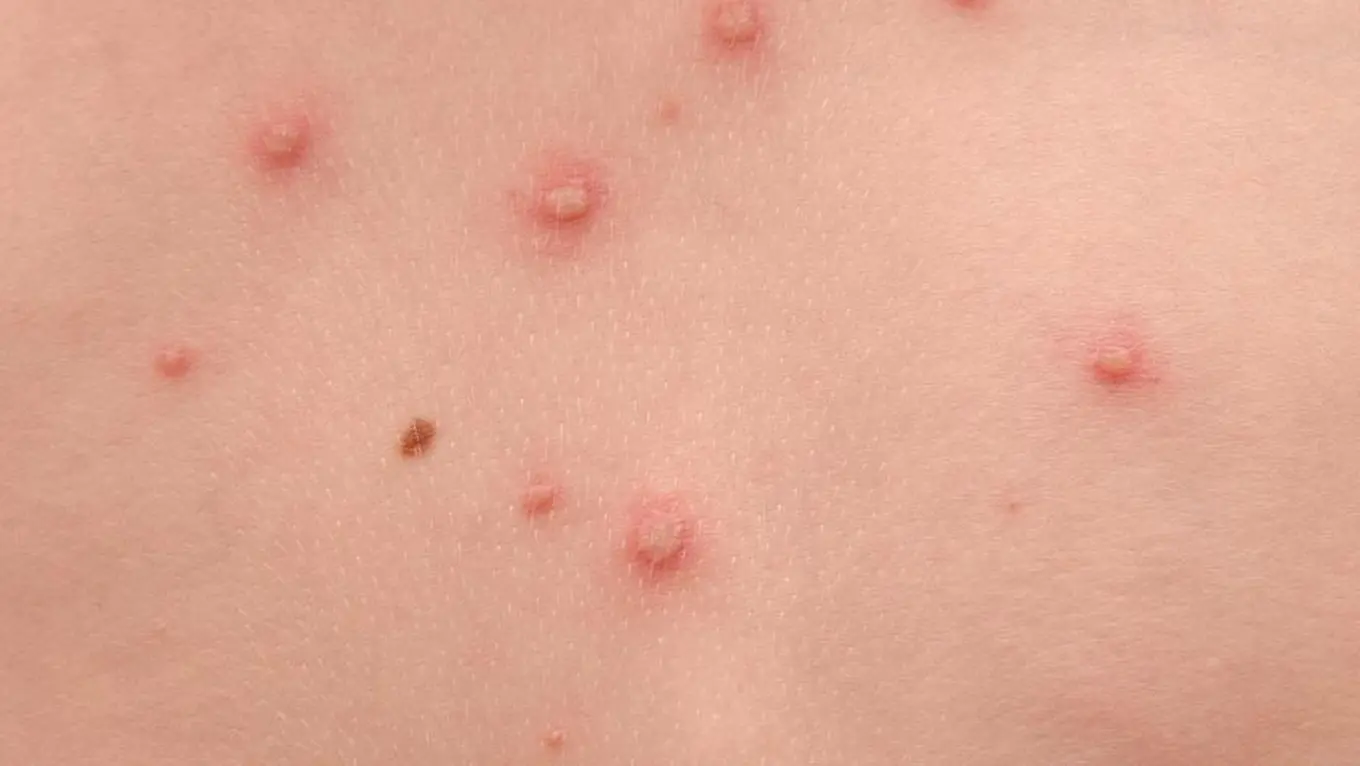 Mengenal Gejala Cacar Air pada Anak dan Orang Dewasa, Langkah Awal