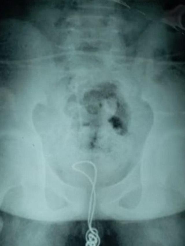 Penasaran Asal Urinenya, Bocah Ini Nekat Masukkan Kawat Sepanjang 70 Cm ke Alat Kelaminnya