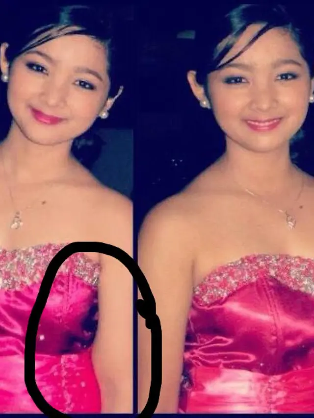 [Bintang] Satu Tangan Diamputasi karena Kanker, Gadis Cantik Ini Berbagi Kisah Hidupnya di Media Sosial