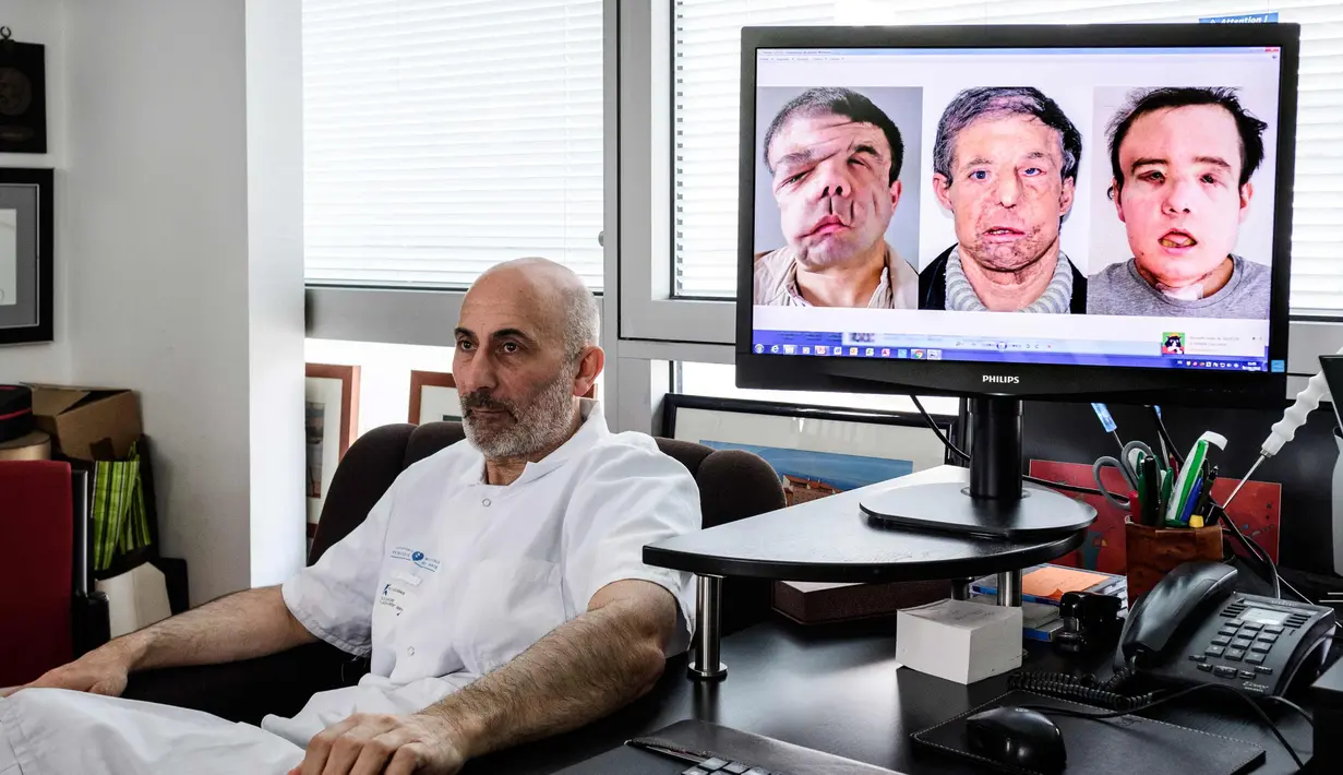 Profesor kedokteran Perancis Laurent Lantieri, seorang spesialis dalam transplantasi tangan dan wajah, berpose di samping layar dari operasi pasien Jerome Hamon  di Hopital Europeen Georges-Pompidou di Paris (13/4). (AFP Photo/Philippe Lopez)
