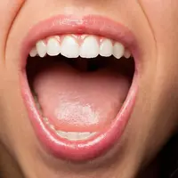 Ilustrasi Cold Sore (Herpes Simplex Virus) Credit: pexels.com/Alex