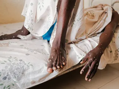 Seorang pria yang terinfeksi Mpox terbaring di tempat tidur di dalam bangsal pusat perawatan Mpox Rumah Sakit Universitas Kamenge di Bujumbura, ibu kota Burundi pada 22 Agustus 2024. (Tchandrou NITANGA / AFP)