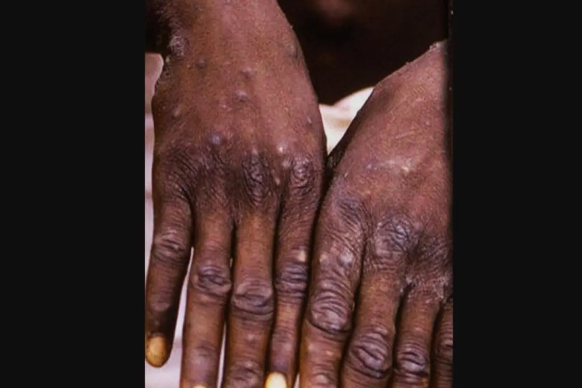 Monkeypox atau penyakit cacar monyet.