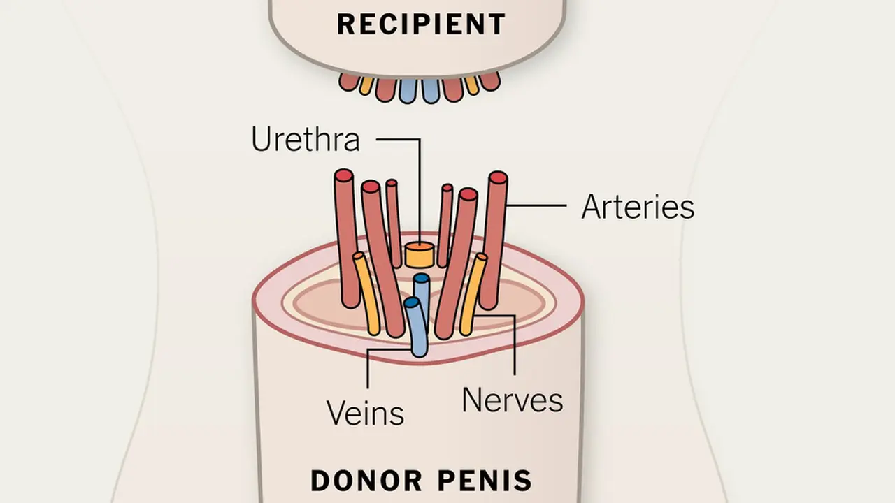 Transplantasi penis