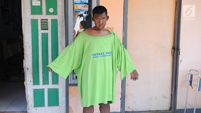 Arya Permana berpose dikediamannya di kawasan Karawang, Jawa Barat, Selasa (9/4). Arya Permana diketahui memiliki berat badan hingga 192 kg, sekarang sudah turun 105 kg menjadi 87 kg pasca operasi lambung. (Liputan6.com/Herman Zakharia)