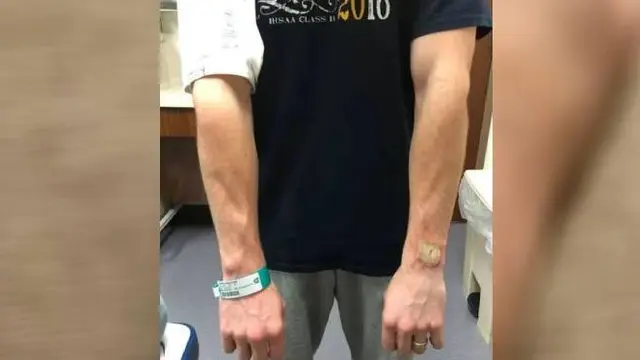 Jam Tangan Pintar Fitbit Meledak di Lengan. Dok: Facebook
