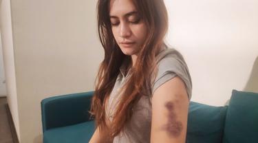 Korban penganiayaan oleh polisi wanita di Pekanbaru memperlihatkan bekas luka yang dialaminya.