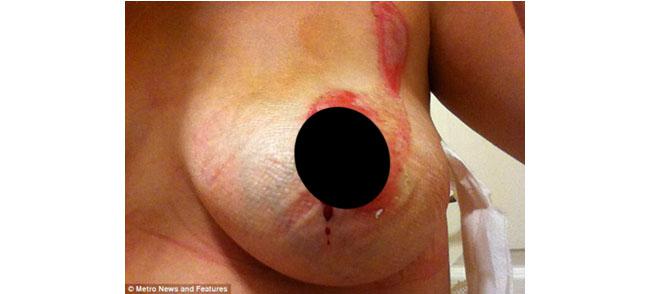 Kondisi payudara Dionne setelah terbakar | Foto: copyright dailymail.co.uk