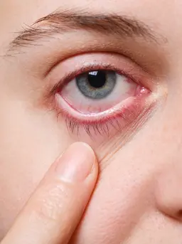 Penyebab dan Cara Mengatasi Bisulan di Kelopak Mata Anak