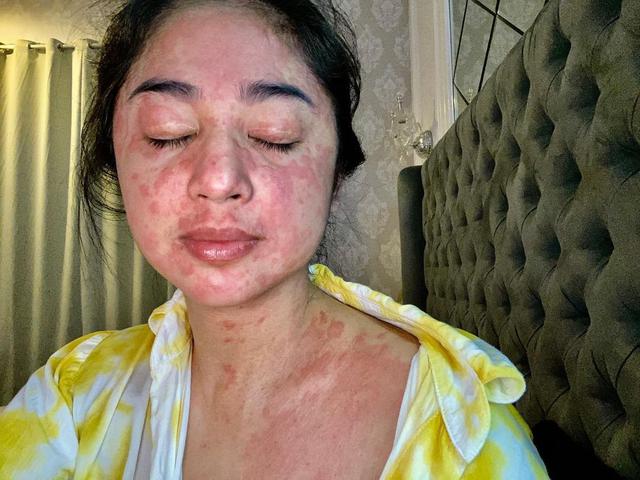 Ciri Ciri Ruam Kulit Gejala Covid 19 Seperti Yang Dialami Dewi Perssik Hot Liputan6 Com