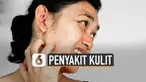 Kelembapan udara akan meningkat saat musim hujan. Kondisi tersebut picu sejumlah masalah penyakit kulit.