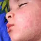 Reaksi alergi pada kulit anak