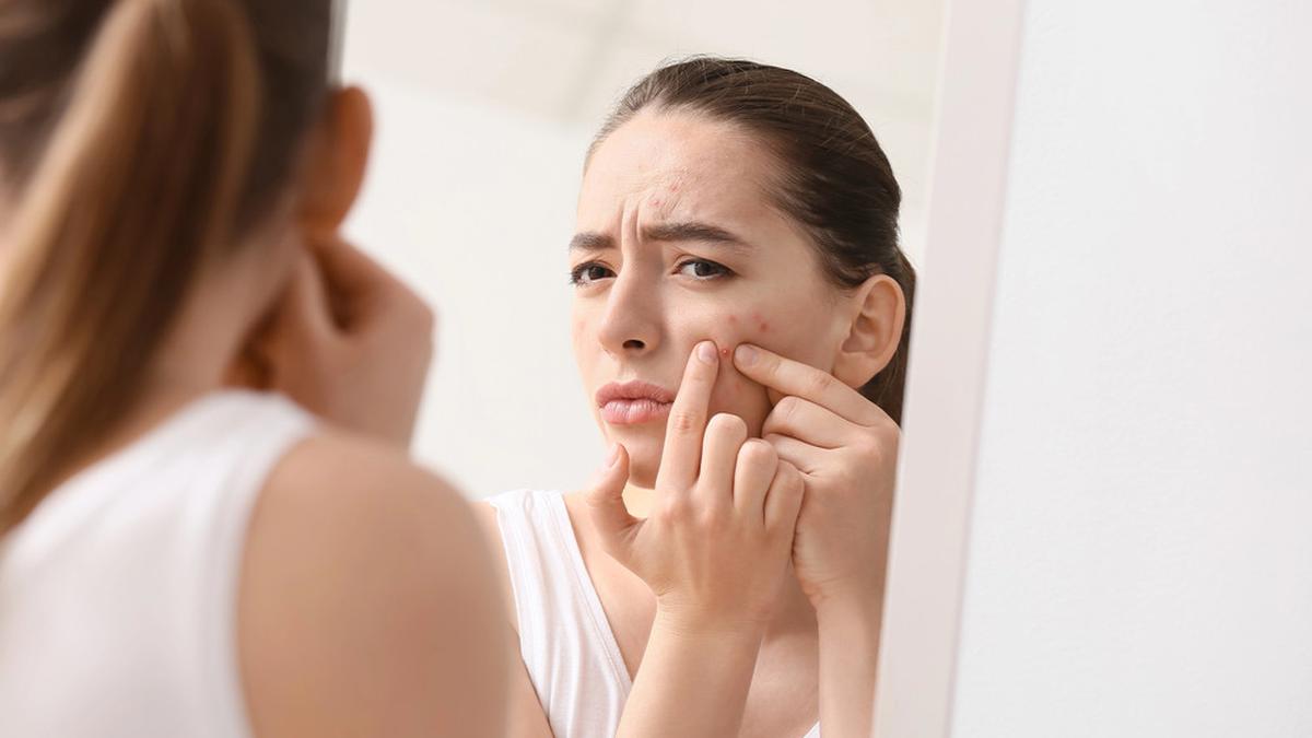 Atasi Jerawat Membandel Akibat Santan Berlebih: Rutinitas Skincare Anti-Jerawat