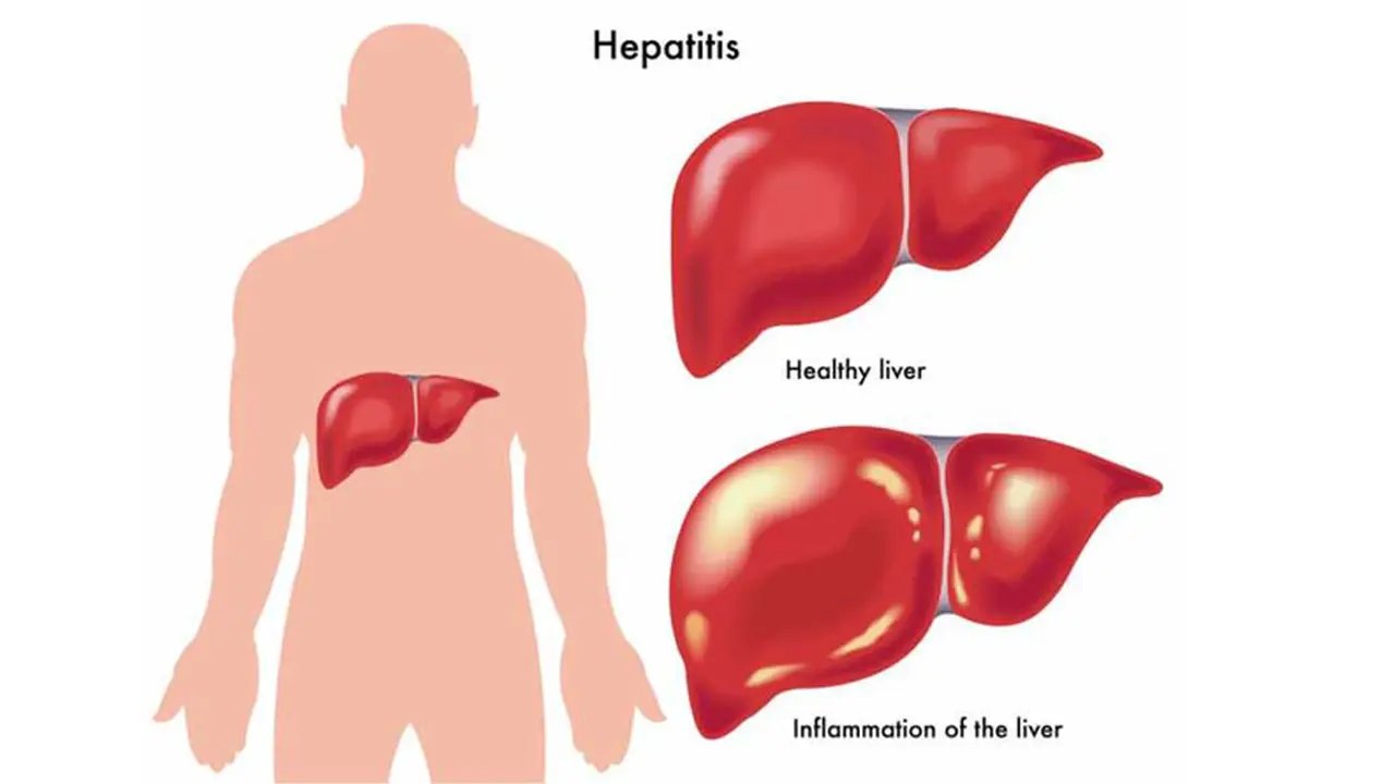 Penderita Hepatitis Banyak yang Tak Sadar Terinfeksi 