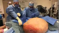 Tumor Seberat 63 Kg Diangkat dari Wanita 71 Tahun