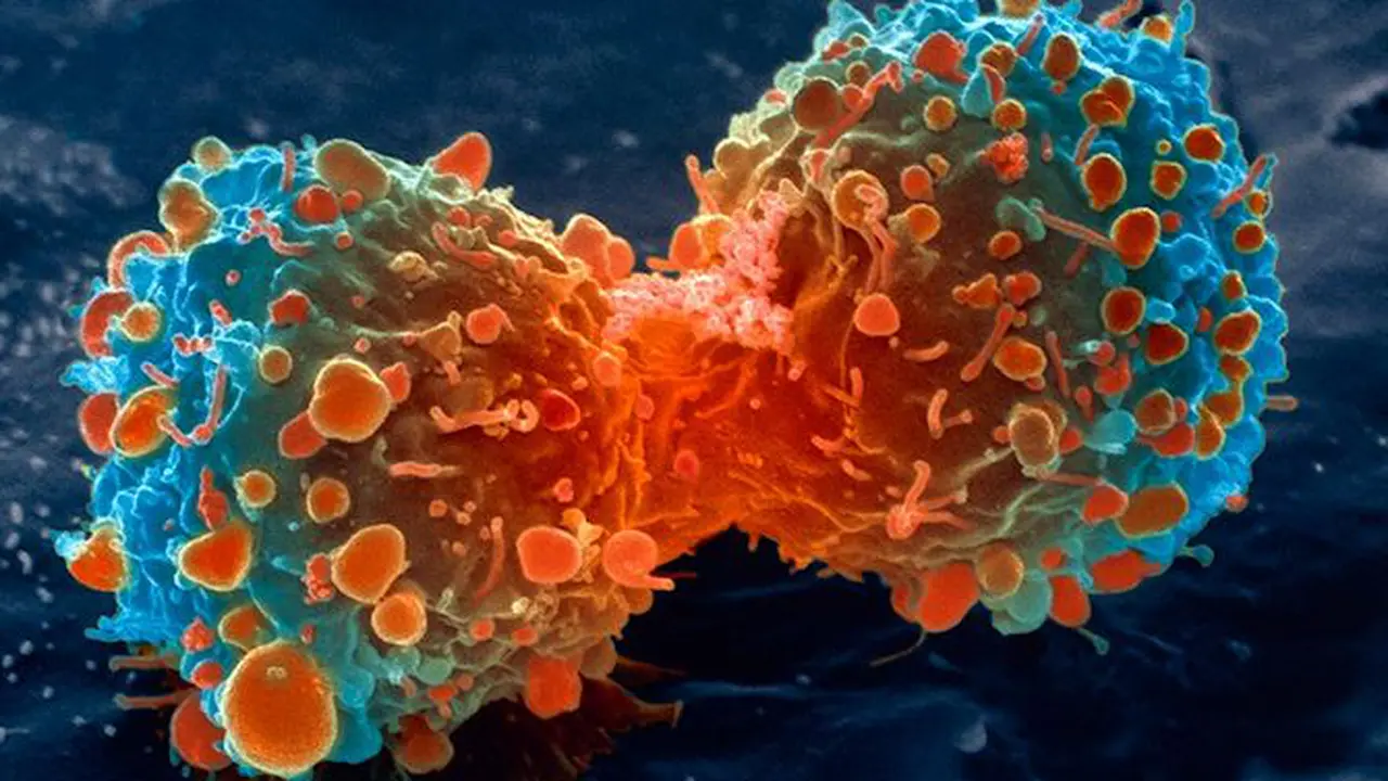 Memahami Beda Tumor, Kista, Abses dan Keganasan