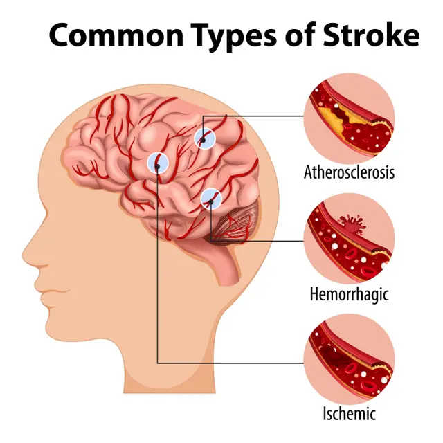 Stroke