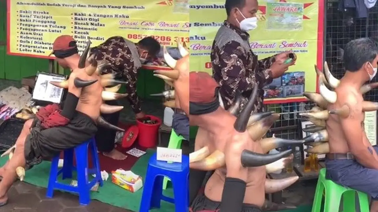 Viral Bekam Pakai Tanduk, Netizen Sebut Pasien Mirip Karakter di Naruto