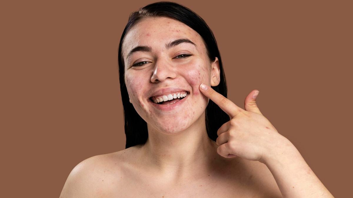 Inovasi Laser Terbaru dengan Pendekatan Skin-First Jadi Solusi Atasi Kulit Kemerahan dan Bekas Jerawat