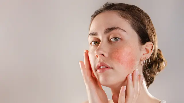 Iritasi Wajah karena Skincare: Kenali Ciri-ciri dan Cara Mengatasinya dengan Tepat