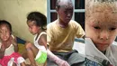 Ternyata kasus 'manusia bersisik' ditemukan di beberapa tempat. Berikut kasus beberapa orang yang memiliki kelainan kulit: (Istimewa) 