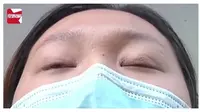 Gagal Oplas, Kelopak Mata Wanita Ini Tak Bisa Tertutup Selama Setahun
