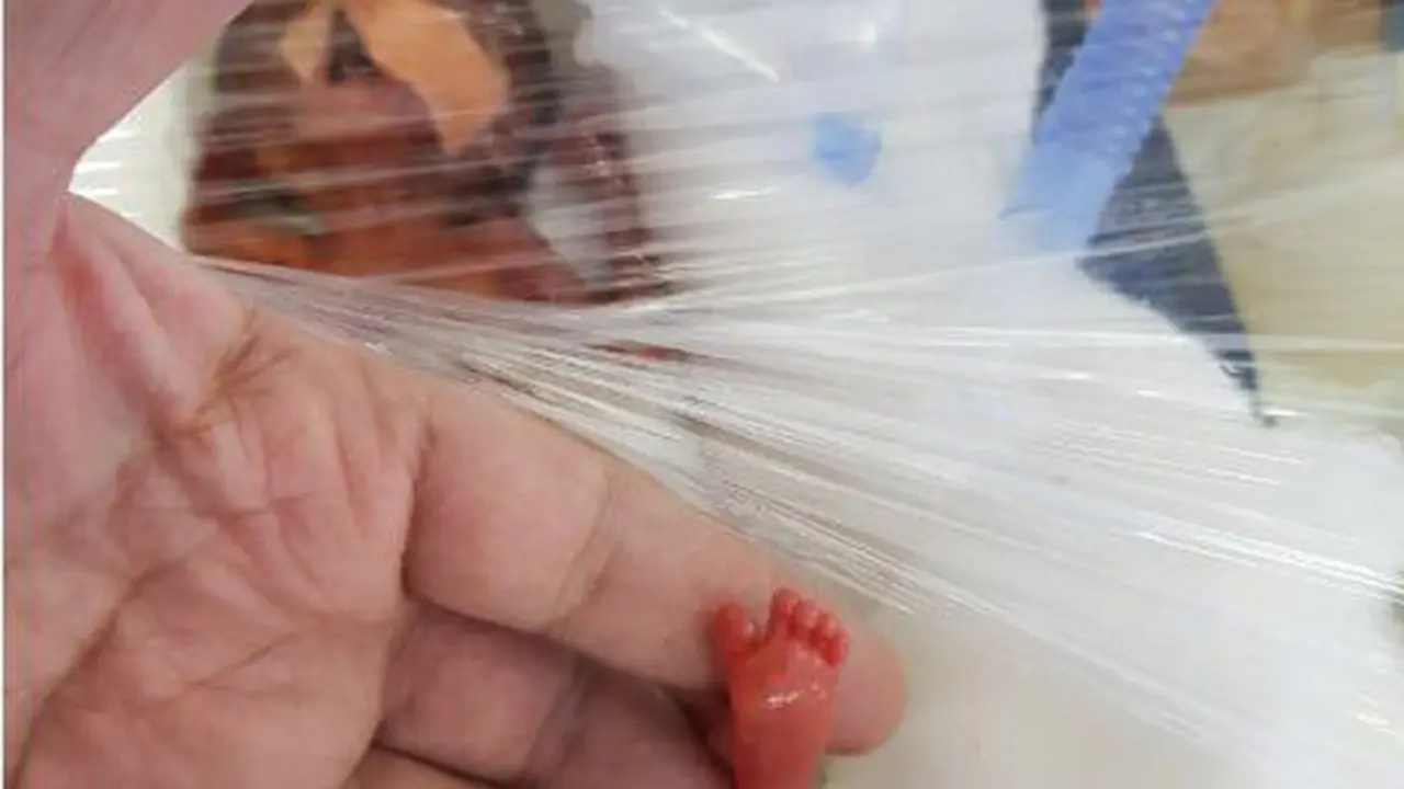 Miliki Berat 400 Gram, Bayi Mungil Ini Mampu Bertahan Hidup