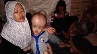 Ilham Putra Usman, bocah tiga tahun asal Desa Ranjeng, Kecamatan Ciruas, Serang, Banten, menderita hidrosefalus sejak dalam kandungan. (Liputan6.com/Yandhi Deslatama)