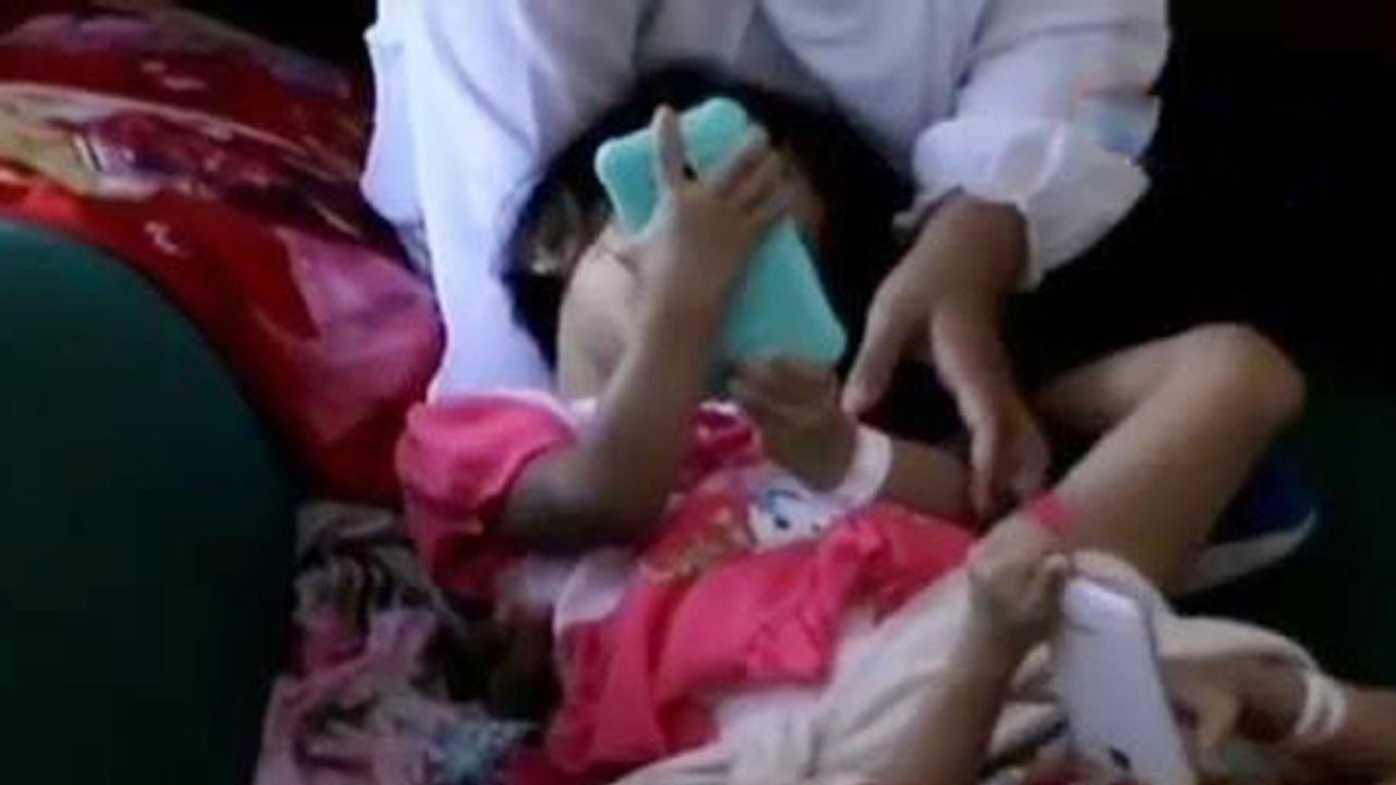 Kembar Siam Balita Devina-Devani