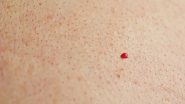 Bintik Merah Pertanda Tumor Muncul di Kulit, Haruskah Khawatir?
