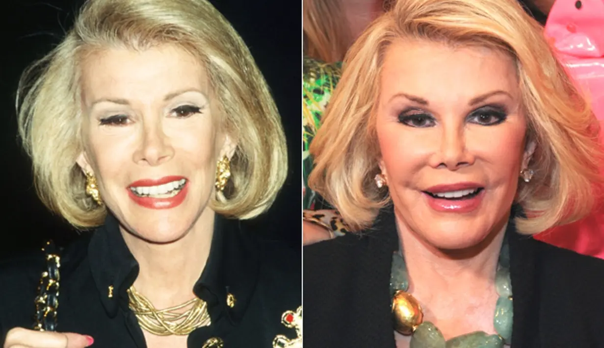 Joan Rivers mengaku melakukan sederet operasi plastik. Menurut kamu lebih cantik yang dulu atau sekarang? (StarCrush)