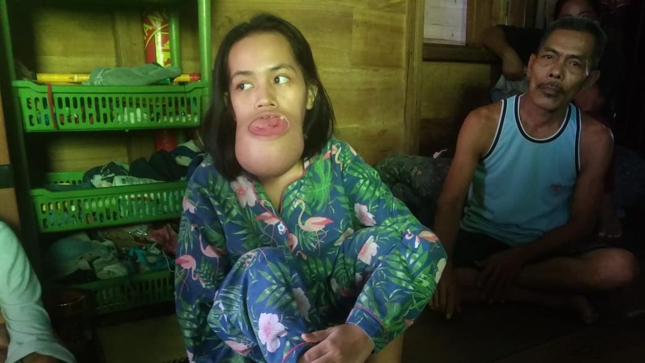 Remaja di Palembang Idap Tumor Mandibula Butuh Uluran Bantuan