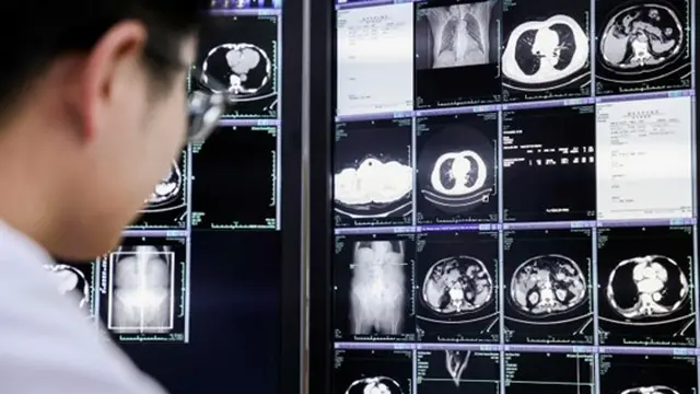 Dokter di Lishui, provinsi Zhejiang, pesisir timur Cina,  memeriksa hasil pemindaian CT scan guna mencari tanda-tanda kanker. (Dok Alibaba)