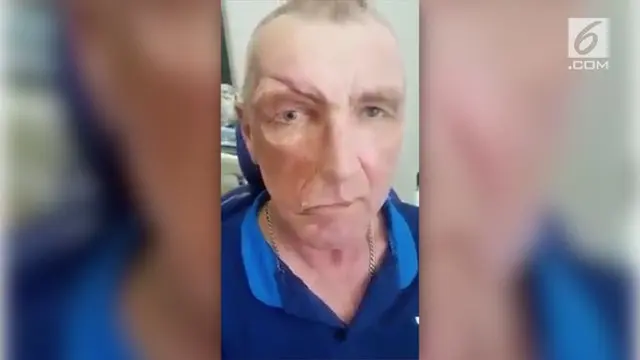 Seorang pria paruh baya mengalami kerusakan wajah, sehingga ia harus memakai wajah palsu yang dapat dibongkar pasang