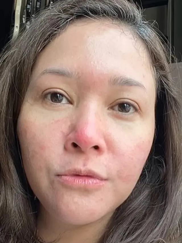 Maia Estianty derita rosacea (Instagram/maiaestiantyreal)