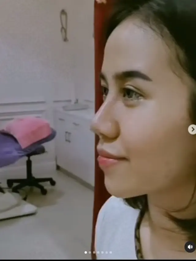 8 Potret Perubahan Wajah Mayang Usai Operasi Hidung, Sudah Lepas Perban