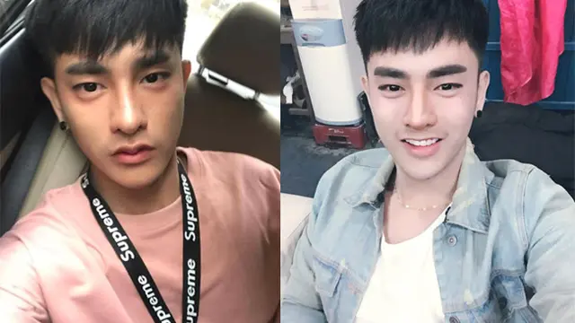 Benci Wajahnya, Pria Ini 30 Kali Operasi Plastik Agar Jadi Ganteng